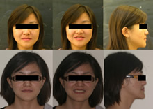 三級擁擠拔牙症例(一)