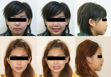 中線偏斜不對稱拔牙症案例